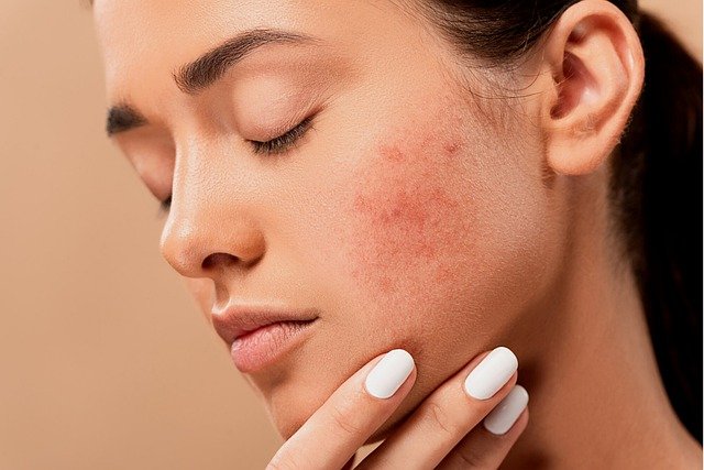 Improve Acne Scars